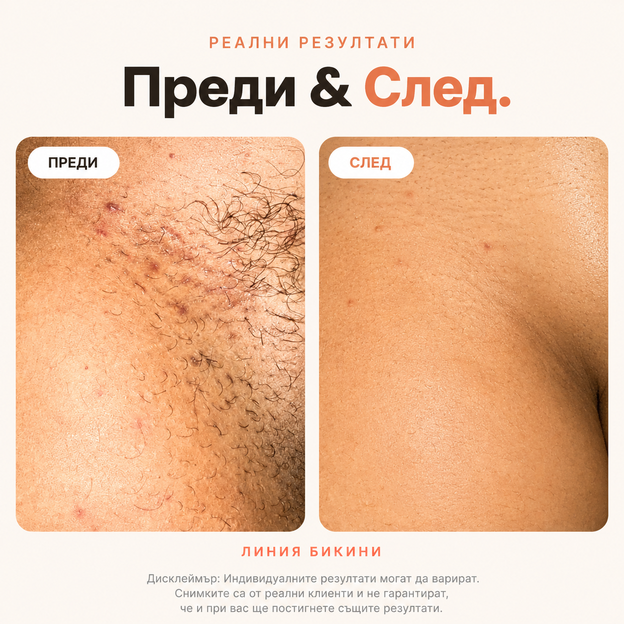 BBL Serum Гладка кожа. Без врастнали косъмчета.