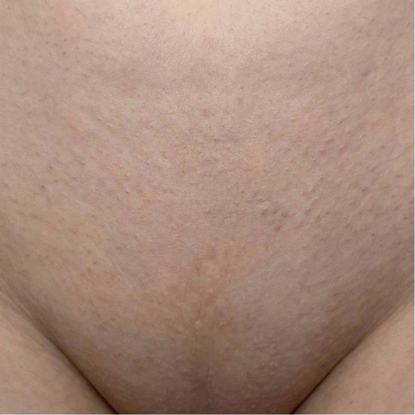 Кожа след употреба на BBL Serum